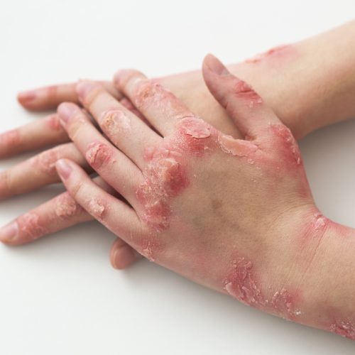 حروق Burns and wound care unit